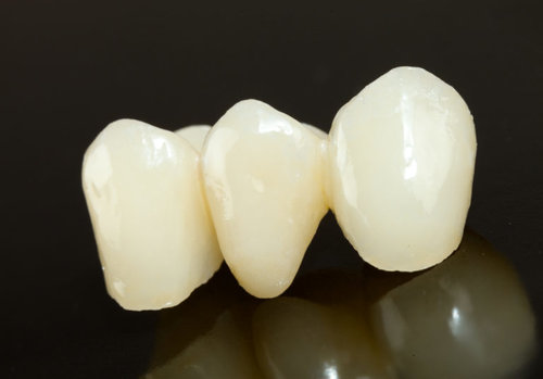 Pikesville Dental Associates - Crowns and Bridges