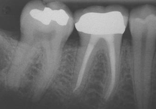 Pikesville Dental Associates - Root Canal Therapy