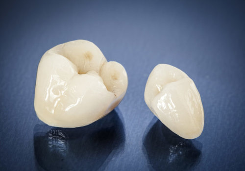 Pikesville Dental Associates - Restore Implants